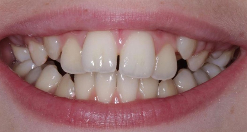 Avant traitement orthodontique au Maroc , Casablanca